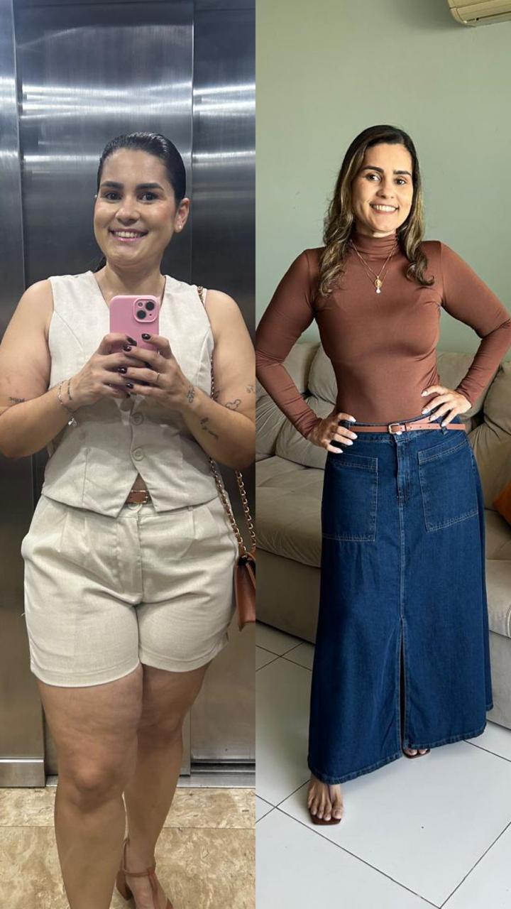 Resultado real de paciente da Clínica São Raimundo: antes e depois do emagrecimento